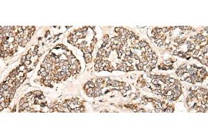 Immunohistochemistry of paraffin-embedded Human esophagus cancer tissue using C1S Polyclonal Antibody at dilution of 1:55(x200) (C1S antibody)