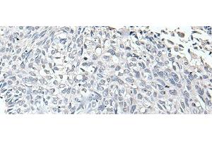 Immunohistochemistry of paraffin-embedded Human lung cancer tissue using RERG Polyclonal Antibody at dilution of 1:65(x200)