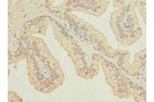 Immunohistochemistry of paraffin-embedded human prostate cancer using ABIN7164612 at dilution of 1:100 (OSGEPL1 antibody  (AA 1-270))