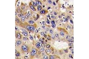 IHC analysis of FFPE human hepatocarcinoma stained with HDAC6 antibody (HDAC6 antibody  (AA 1182-1215))