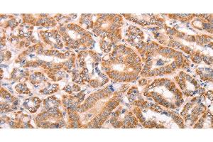 Immunohistochemistry of paraffin-embedded Human thyroid cancer tissue using TRPV4 Polyclonal Antibody at dilution 1:40 (TRPV4 antibody)