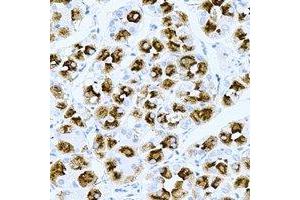 Immunohistochemical analysis of TPPP3 staining in human gastric cancer formalin fixed paraffin embedded tissue section.