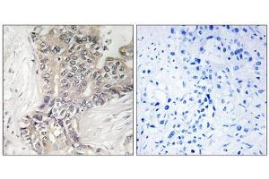 Immunohistochemistry analysis of paraffin-embedded human liver carcinoma tissue using B3GALTL antibody. (B3GALTL antibody  (C-Term))