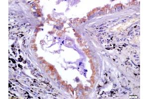 Formalin-fixed and paraffin embedded human lung carcinoma labeled with Anti-LAG-3/CD223 Polyclonal Antibody, Unconjugated (ABIN748508) at 1:200 followed by conjugation to the secondary antibody and DAB staining (LAG3 antibody  (AA 201-300))