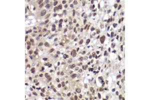 Immunohistochemistry of paraffin-embedded human lung cancer using CHEK2 antibody. (CHEK2 antibody  (AA 1-220))