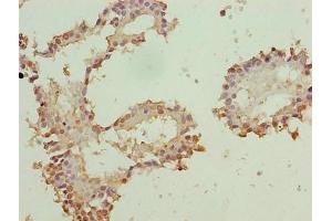 Immunohistochemistry of paraffin-embedded human breast cancer using ABIN7176136 at dilution of 1:100 (ZNF184 antibody  (AA 1-751))