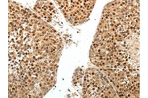 The image on the left is immunohistochemistry of paraffin-embedded Human liver cancer tissue using ABIN7131160(SPATA2L Antibody) at dilution 1/30, on the right is treated with fusion protein. (SPATA2L antibody)
