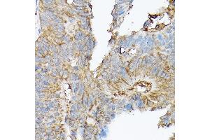 Immunohistochemistry of paraffin-embedded human colon carcinoma using SLC8 Rabbit pAb (ABIN6132664, ABIN6148050, ABIN6148052 and ABIN6221228) at dilution of 1:100 (40x lens). (SLC8A1 antibody  (AA 250-520))