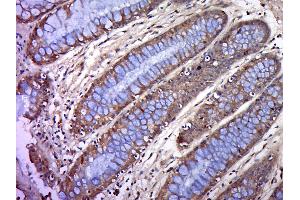Formalin-fixed and paraffin embedded human colon cancer labeled with BTN2A1 Polyclonal Antibody, Unconjugated (bs-20473R) at 1:200, followed by conjugation to the secondary antibody and DAB staining (BTN2A1 antibody  (AA 101-200))
