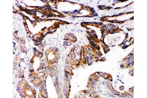Anti-DCC antibody, IHC(P) IHC(P): Human Intestinal Cancer Tissue