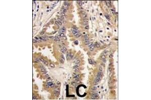 Formalin-fixed and paraffin-embedded human lung carcinoma tissue reacted with Bad antibody (Center), which was peroxidase-conjugated to the secondary antibody, followed by DAB staining. (BAD antibody  (AA 53-81))