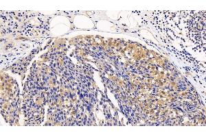 Detection of EIF4EBP1 in Human Breast cancer Tissue using Polyclonal Antibody to Eukaryotic Translation Initiation Factor 4E Binding Protein 1 (EIF4EBP1) (eIF4EBP1 antibody  (AA 2-118))