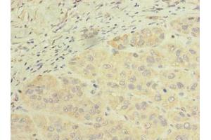 Immunohistochemistry of paraffin-embedded human liver cancer using ABIN7168643 at dilution of 1:100 (SCFD2 antibody  (AA 255-470))