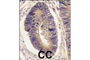 Formalin-fixed and paraffin-embedded human colon carcinoma tissue reacted with PTPH1 antibody (Center), which was peroxidase-conjugated to the secondary antibody, followed by DAB staining. (PTPN3 antibody  (AA 366-397))