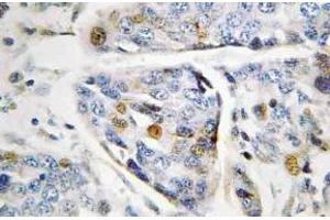 Immunohistochemistry (IHC) analyzes of Lamin A antibody in paraffin-embedded human breast carcinoma tissue. (Lamin A/C antibody)