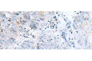 Immunohistochemistry of paraffin-embedded Human colorectal cancer tissue using POMC Polyclonal Antibody at dilution of 1:35(x200) (POMC antibody)