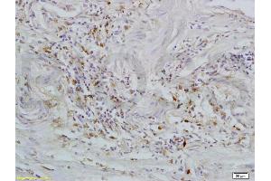Formalin-fixed and paraffin embedded human rectal carcinoma tissue labeled with Rabbit Anti-GPR30 Polyclonal Antibody (ABIN685717) at 1:200 followed by conjugation to the secondary antibody and DAB staining. (GPER antibody  (AA 251-375))