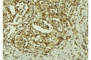 ABIN6273150 at 1/100 staining Human breast cancer tissue by IHC-P. (PRPF8 antibody  (C-Term))