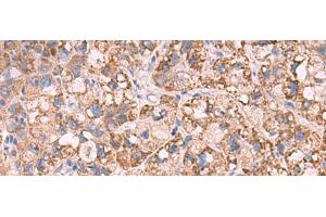 Immunohistochemistry of paraffin-embedded Human liver cancer tissue using KCNN1 Polyclonal Antibody at dilution of 1:55(x200) (KCNN1 antibody)