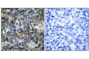 Immunohistochemical analysis of paraffin-embedded human tonsil carcinoma tissue, using VASP (phospho-Ser238) antibody (E011158). (VASP antibody  (pSer238))