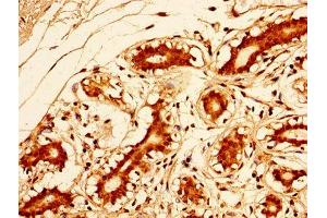 IHC image of ABIN7172615 diluted at 1:500 and staining in paraffin-embedded human breast cancer performed on a Leica BondTM system. (SOX2 antibody  (AA 1-317))