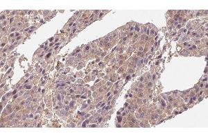 ABIN6276716 at 1/100 staining Human liver cancer tissue by IHC-P. (CD4 antibody  (C-Term))