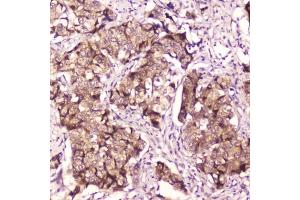 IHC testing of FFPE human breast cancer with p65 antibody at 2ug/ml. (NF-kB p65 antibody  (AA 99-551))