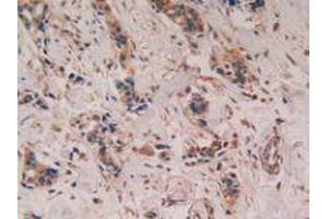 IHC-P analysis of Human Breast Cancer Tissue, with DAB staining. (PTGS2 antibody  (AA 418-589))