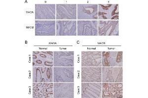 Immunohistochemical (IHC) results of monoamine oxidase A (MAOA) and MAOB expressions in a Taiwanese colorectal cancer cohort. (Monoamine Oxidase A antibody  (Center))