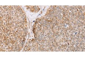 Immunohistochemistry of paraffin-embedded Human lung cancer tissue using YARS2 Polyclonal Antibody at dilution 1:30 (YARS2 antibody)