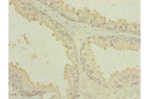 Immunohistochemistry of paraffin-embedded human prostate cancer using ABIN7172904 at dilution of 1:100 (MTIF3 antibody  (AA 1-278))