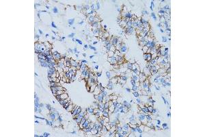 Immunohistochemistry of paraffin-embedded human colon carcinoma using LGALS8 antibody.