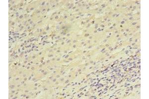 Immunohistochemistry of paraffin-embedded human liver cancer using ABIN7168458 at dilution of 1:100 (UTP23 antibody  (AA 1-249))