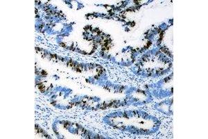 Immunohistochemical analysis of AEBP2 staining in human colon cancer formalin fixed paraffin embedded tissue section. (AEBP2 antibody)
