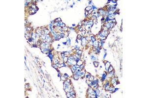 Immunohistochemistry of paraffin-embedded Human colon carcinoma using STNL Rabbit pAb (ABIN7270585) at dilution of 1:100 (40x lens). (STARD3NL antibody  (AA 185-234))