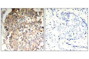 Immunohistochemical analysis of paraffin-embedded human breast carcinoma tissue using SHP-1(Phospho-Tyr536) Antibody(left) or the same antibody preincubated with blocking peptide(right). (SHP1 antibody  (pTyr536))