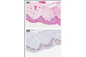 Immunohistochemical analysis of PDCD4 shows the corresponding H&E-stained and PDCD4-stained tissue sections from patients with OSCC. (PDCD4 antibody  (pSer457))