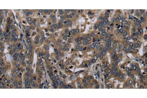 Immunohistochemistry of paraffin-embedded Human liver cancer tissue using FGF18 Polyclonal Antibody at dilution 1:40 (FGF18 antibody)