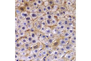 Immunohistochemistry of paraffin-embedded human liver cancer using TCTN3 antibody at dilution of 1:100 (40x lens).
