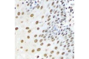 Immunohistochemical analysis of Karyopherin alpha-3 staining in human esophageal cancer formalin fixed paraffin embedded tissue section. (KPNA3 antibody)