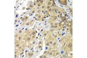 Immunohistochemistry of paraffin-embedded human liver cancer using SGTA antibody. (SGTA antibody  (AA 1-120))