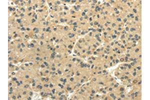 The image on the left is immunohistochemistry of paraffin-embedded Human liver cancer tissue using ABIN7131516(TULP2 Antibody) at dilution 1/20, on the right is treated with fusion protein. (TULP2 antibody)