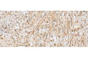 Immunohistochemistry of paraffin-embedded Human liver cancer tissue using NUP58 Polyclonal Antibody at dilution of 1:50(x200) (NUPL1 antibody)