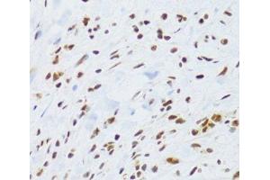 Immunohistochemistry of paraffin-embedded Human gastric cancer using DDB1 Polyclonal Antibody at dilution of 1:100 (40x lens). (DDB1 antibody)