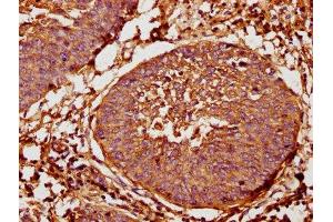 IHC image of ABIN7144329 diluted at 1:400 and staining in paraffin-embedded human cervical cancer performed on a Leica BondTM system.