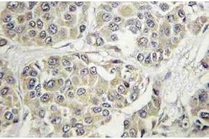 Immunohistochemistry (IHC) analyzes of Tyk 2 antibody in paraffin-embedded human breast carcinoma tissue.