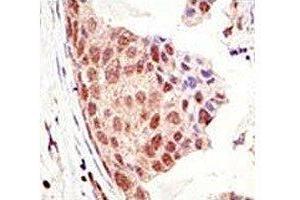IHC analysis of FFPE human breast carcinoma tissue stained with the SUMO antibody (SUMO1 antibody  (AA 55-86))