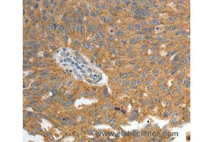 Immunohistochemistry of Human ovarian cancer using GRK4 Polyclonal Antibody at dilution of 1:40 (GRK4 antibody)