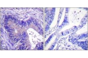 Immunohistochemistry analysis of paraffin-embedded human colon carcinoma, using ATP-Citrate Lyase (Phospho-Ser454) Antibody. (ACLY antibody  (pSer455))