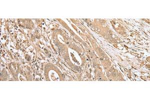 Immunohistochemistry of paraffin-embedded Human gastric cancer tissue using FNDC3B Polyclonal Antibody at dilution of 1:45(x200) (FNDC3B antibody)